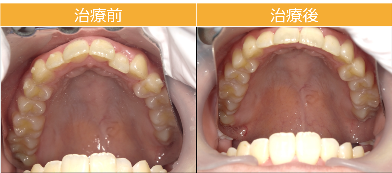 インビザラインiGoビフォー・アフター